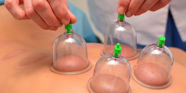 Cupping therapy set applied along a client's back